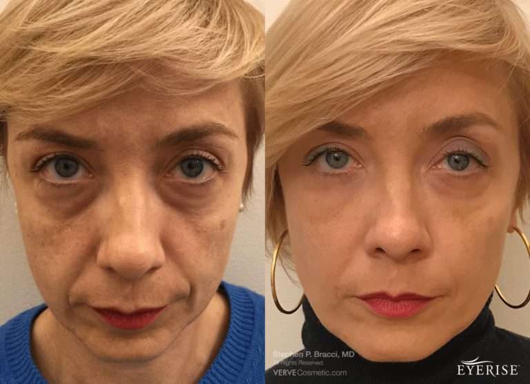 Eyebag Treatments 5 Options Verve Laser