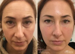 Non-Surgical-Removal-Of-Eyebags-NYC-VERVE-1-1.webp