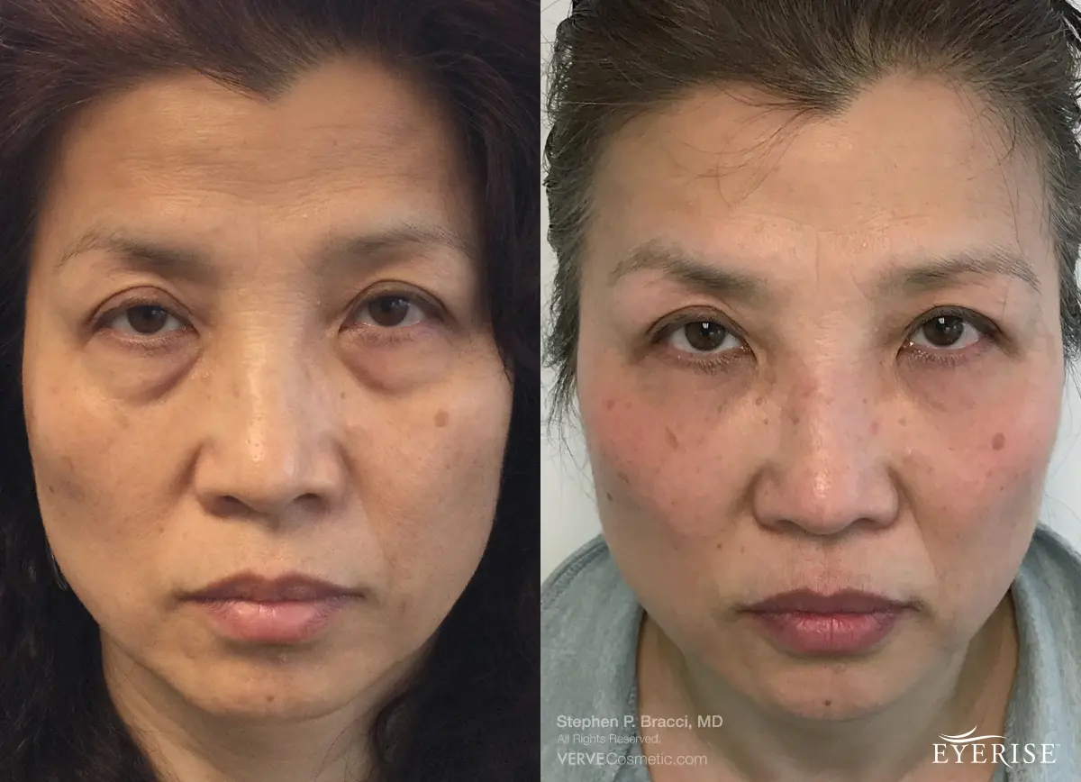 EyeBagRemovalNonSurgicalEyeBags1.webp Verve Medical Cosmetics