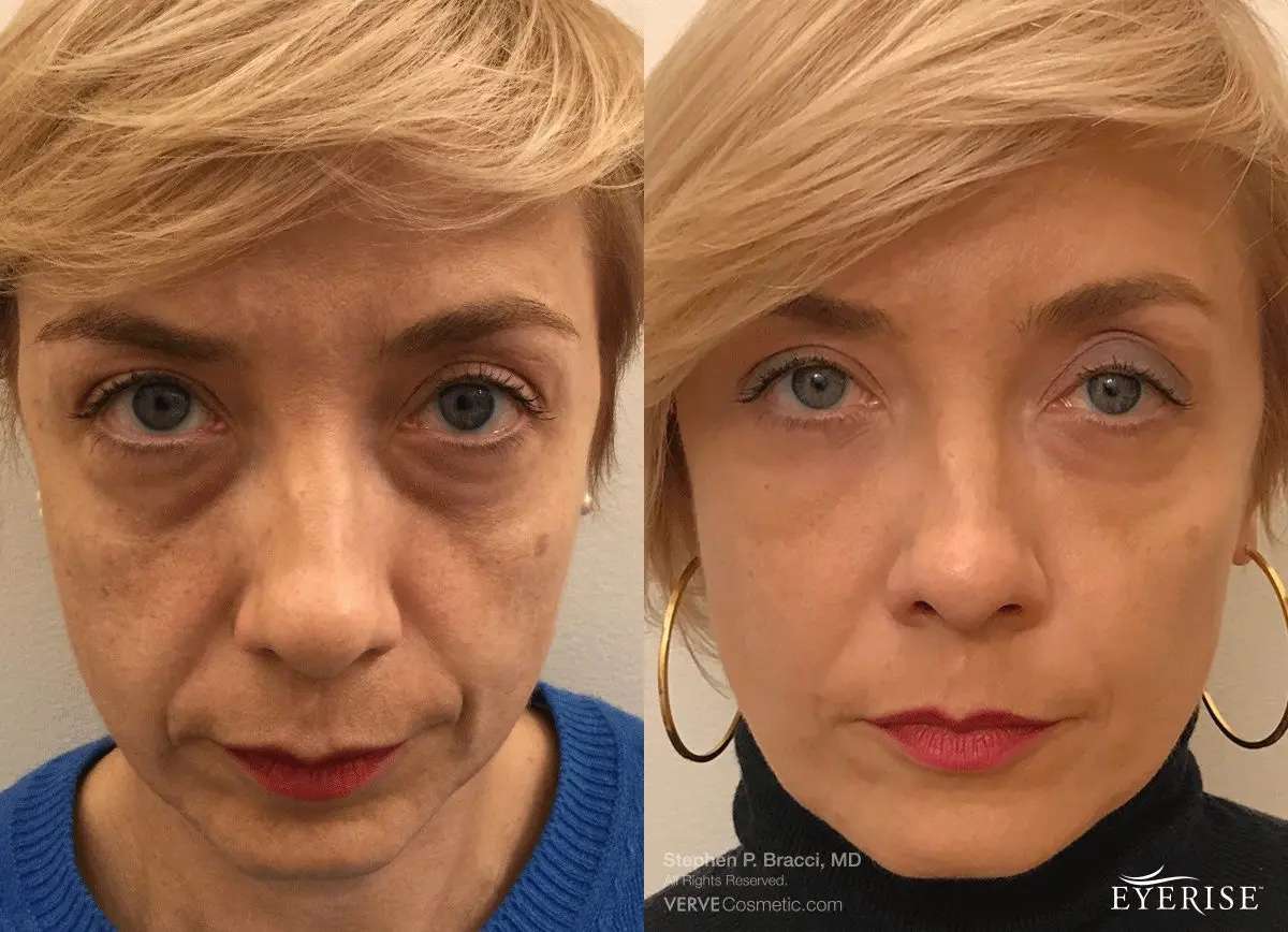 NonSurgicalEYEBagRemovalNYC copy Verve Medical Cosmetics Stephen Bracci, MD