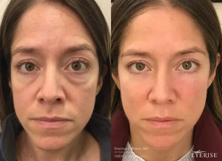 Cosmetic-Fillers-Eye-Lift-Eye-Bags-NYC