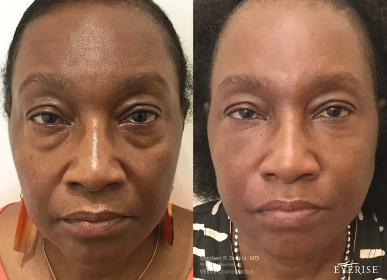 Eye-Bags-Fillers-NYC-Dr-Bracci