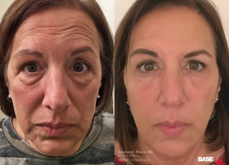 Eye-Bags-Fillers-Non-Surgical-Face-Lift