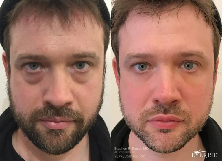 Non-Surgical-Eyebags-Removal-Dr-Bracci