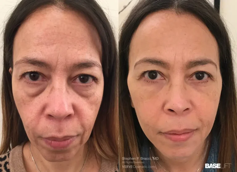 non-surgical-facelift-cosmetic-fillers-Stephen-Bracci-MD