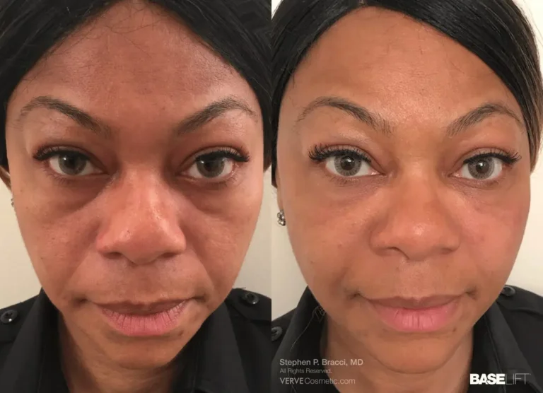 non-surgical-facelift-cosmetic-fillers-nyc-baselift