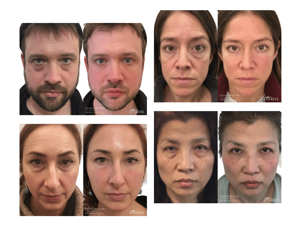 Cheek Fillers For Facial Contouring NYC Before After Photos