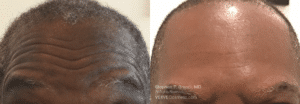 before after forhead botox nyc