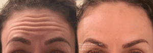 before after forhead lines botox new york