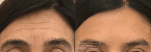 before after forhead lines botox nyc