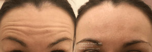 before after results forhead botox nyc