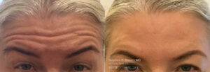 botox nyc before after cosmetic injection