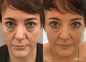eyerise eyebags removal dr bracci nyc